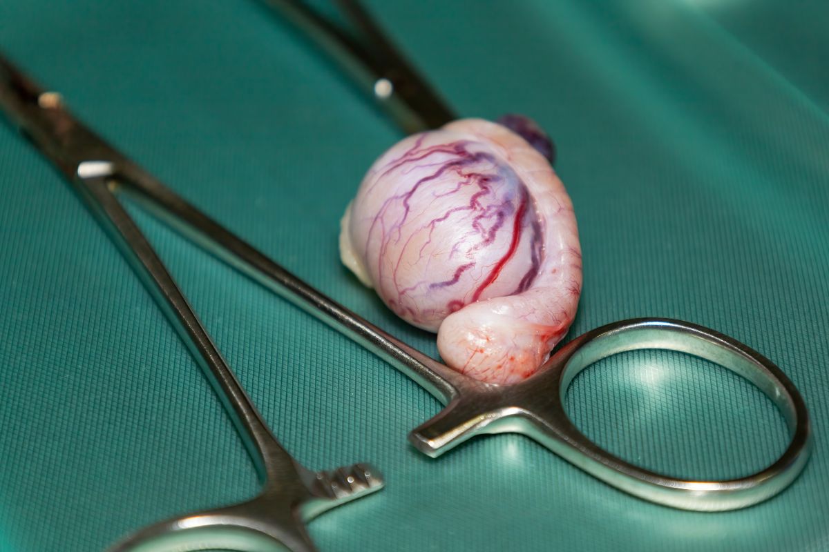 Cirurgia no Testículo: Doenças, Tratamentos e Recuperação