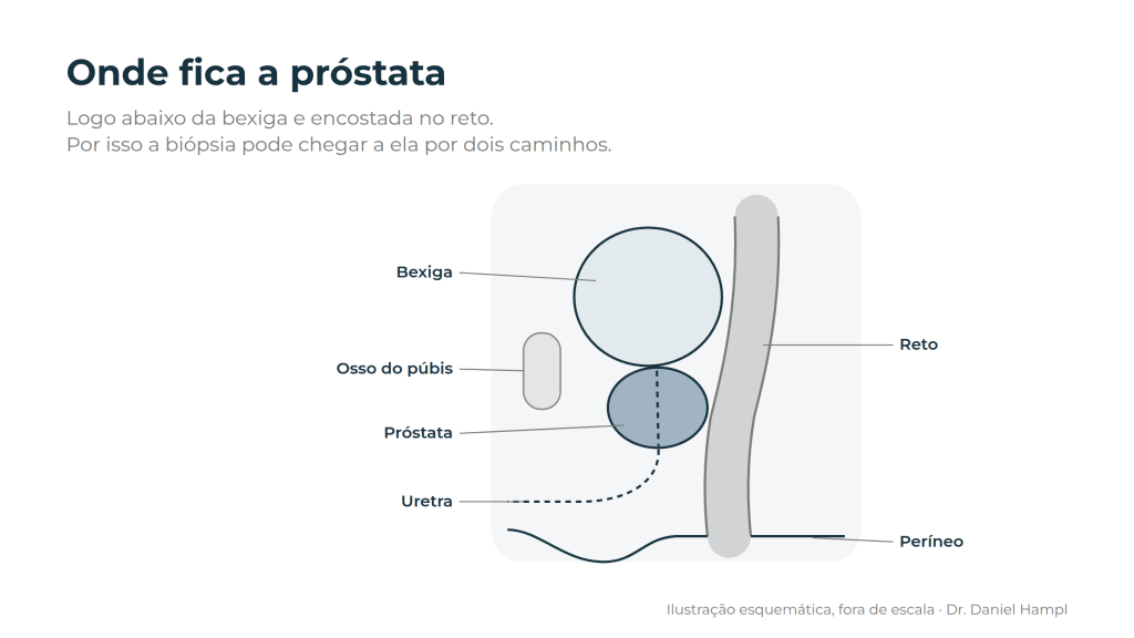 Posição da próstata logo abaixo da bexiga e encostada no reto, o que define os caminhos da biópsia de próstata