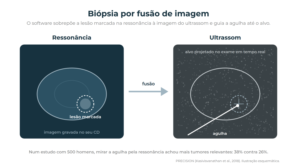 Biópsia de próstata por fusão de imagem: a lesão marcada na ressonância guia a agulha no ultrassom