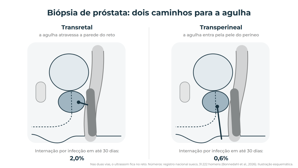 Biópsia de próstata transretal e transperineal lado a lado, com internação por infecção em 30 dias de 2,0% e 0,6%