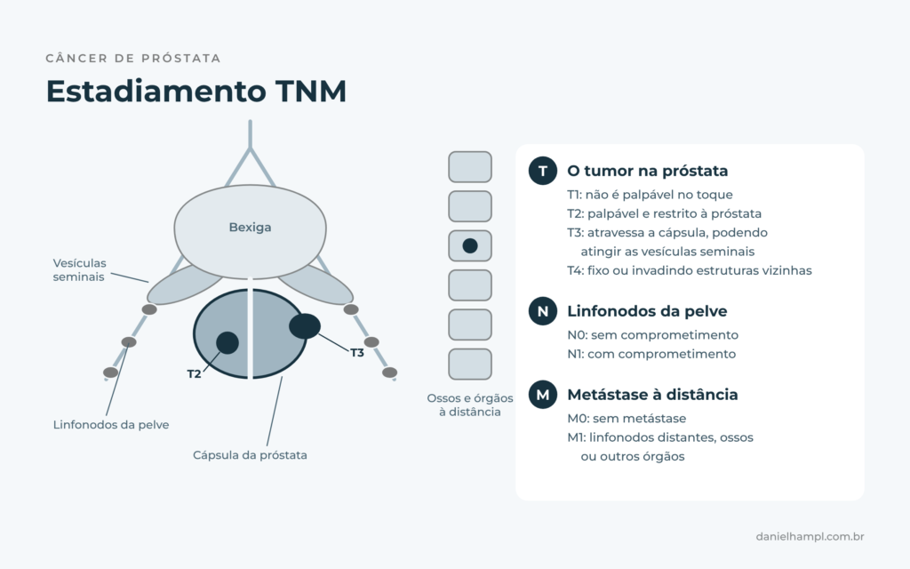 Estadiamento TNM do câncer de próstata: tumor na próstata, linfonodos da pelve e metástase à distância