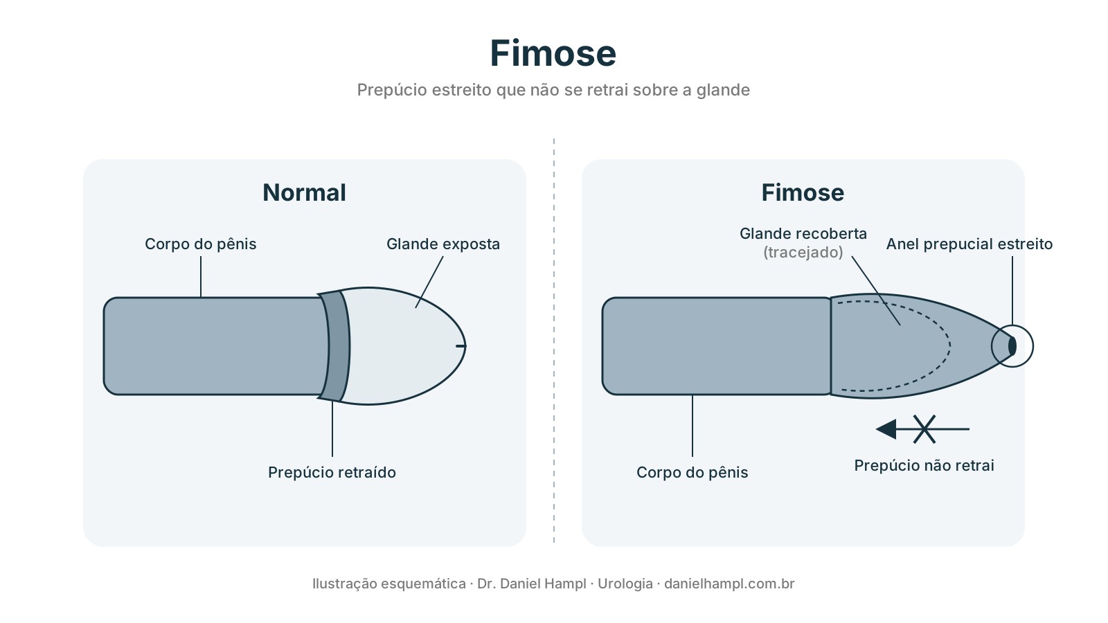 Ilustração comparando pênis normal, com a glande exposta, e pênis com fimose, com o prepúcio estreito que não retrai