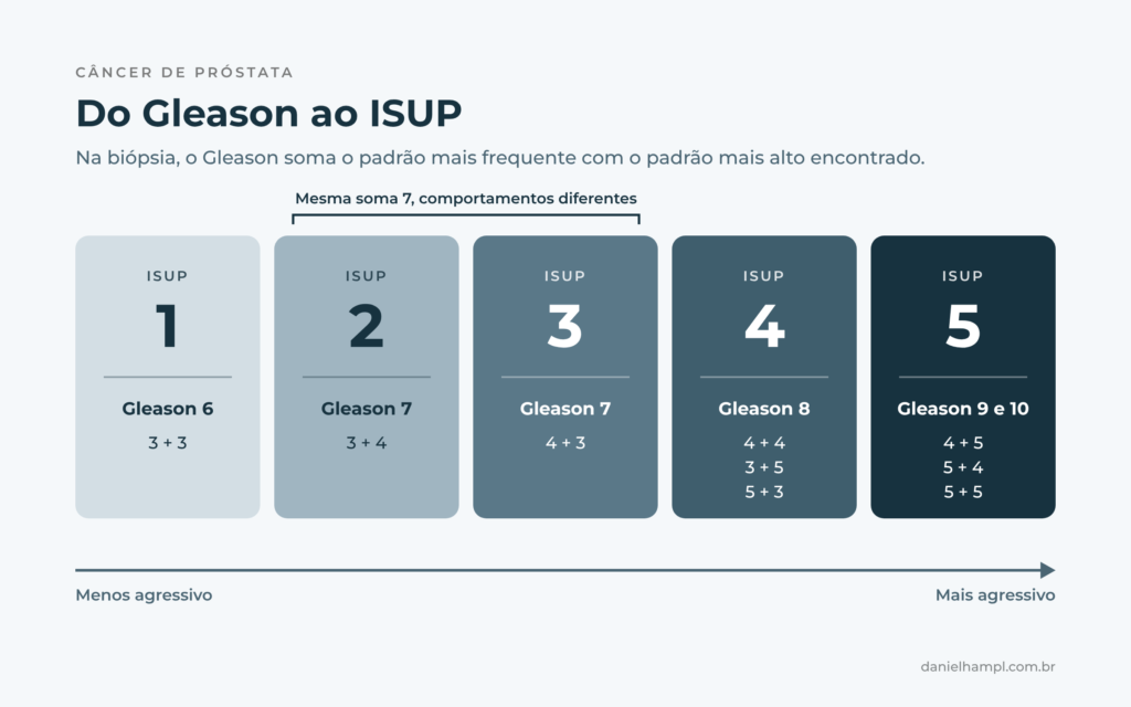 Correspondência entre a escala de Gleason e os grupos ISUP do câncer de próstata, do grupo 1 ao grupo 5