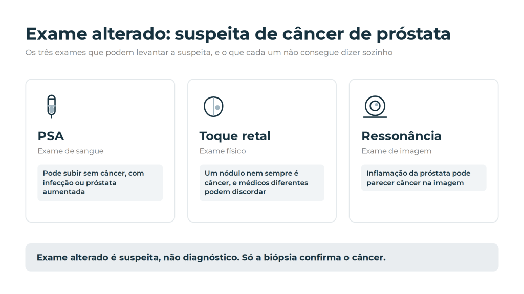 Os três exames que levantam a suspeita de câncer de próstata e seus limites: PSA pode subir sem câncer, nódulo no toque nem sempre é câncer, inflamação pode parecer câncer na ressonância. Só a biópsia confirma