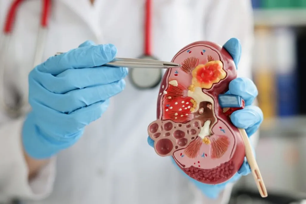 Cálculo Renal: Causas, Sintomas e Tratamentos