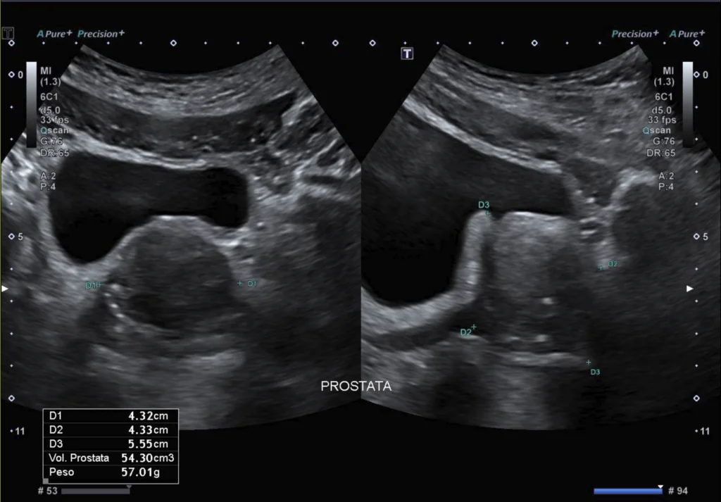 Ultrassonografia da próstata transabdominal mostrando as medidas dos três eixos e o volume calculado da glândula