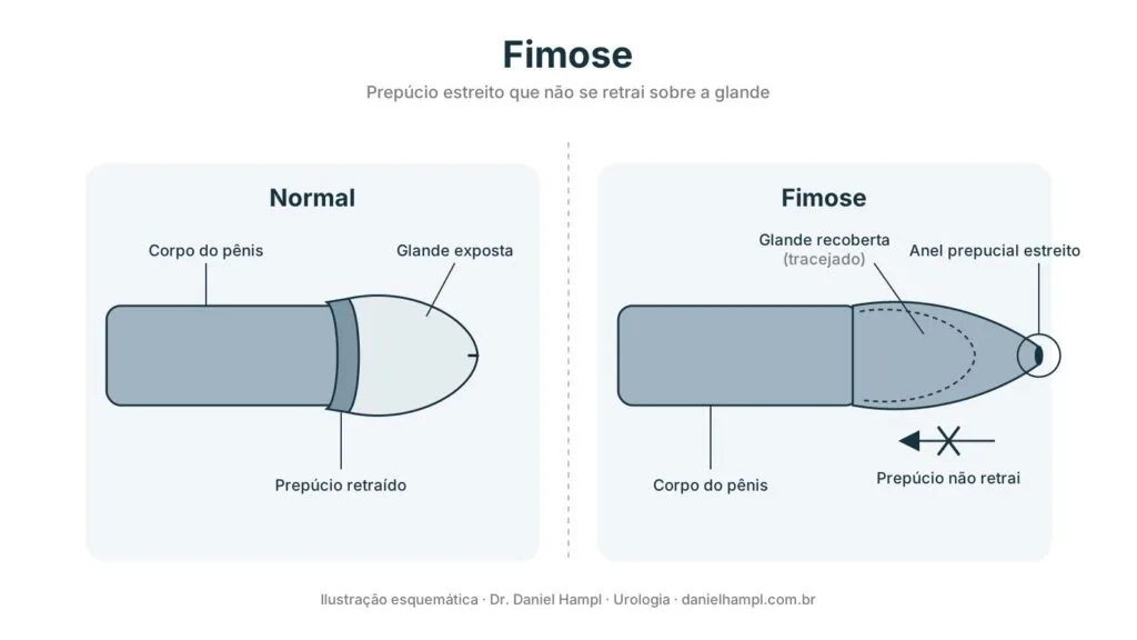 Ilustração comparando pênis normal, com a glande exposta, e pênis com fimose, com o prepúcio estreito que não retrai